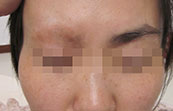 脸部白癜风采用美国308nm准分子激光+中药+食疗治疗康复后